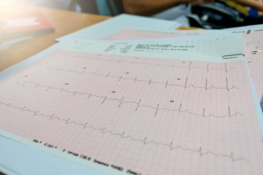 kalp analizi, Elektrokardiyogram (EKG grafiği) 