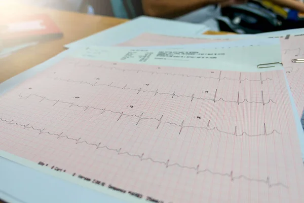 Аналіз серця, граф електрокардіограми (ECG ) — стокове фото