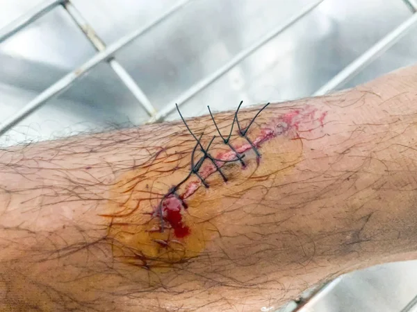 dikiş hastaların hastanede bacaklarda yara.