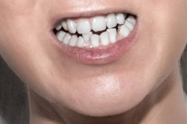 Crooked teeth of a young woman close-up. Orthodontic treatment concept