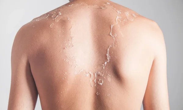 Man with peeling skin from sunburn.