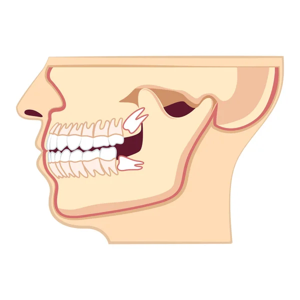 Mänskligt huvud med käke. Onormalt utbrott av tänder, tandvärk — Stock vektor
