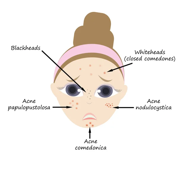 Types of acne — Stock Vector