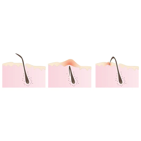 Struktur des Haarfollikels, eingewachsene Haare beim Rasieren und Enthaaren — Stockvektor