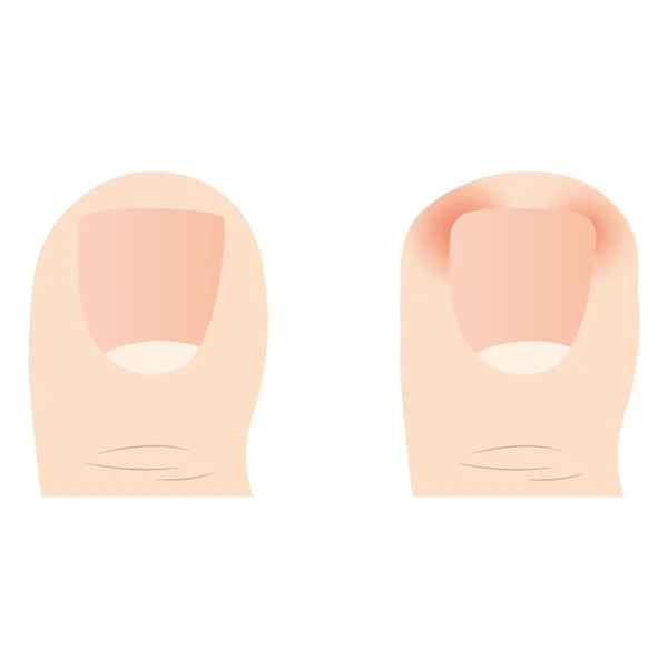 Vector of Common Foot Problems. ongle incarné — Image vectorielle