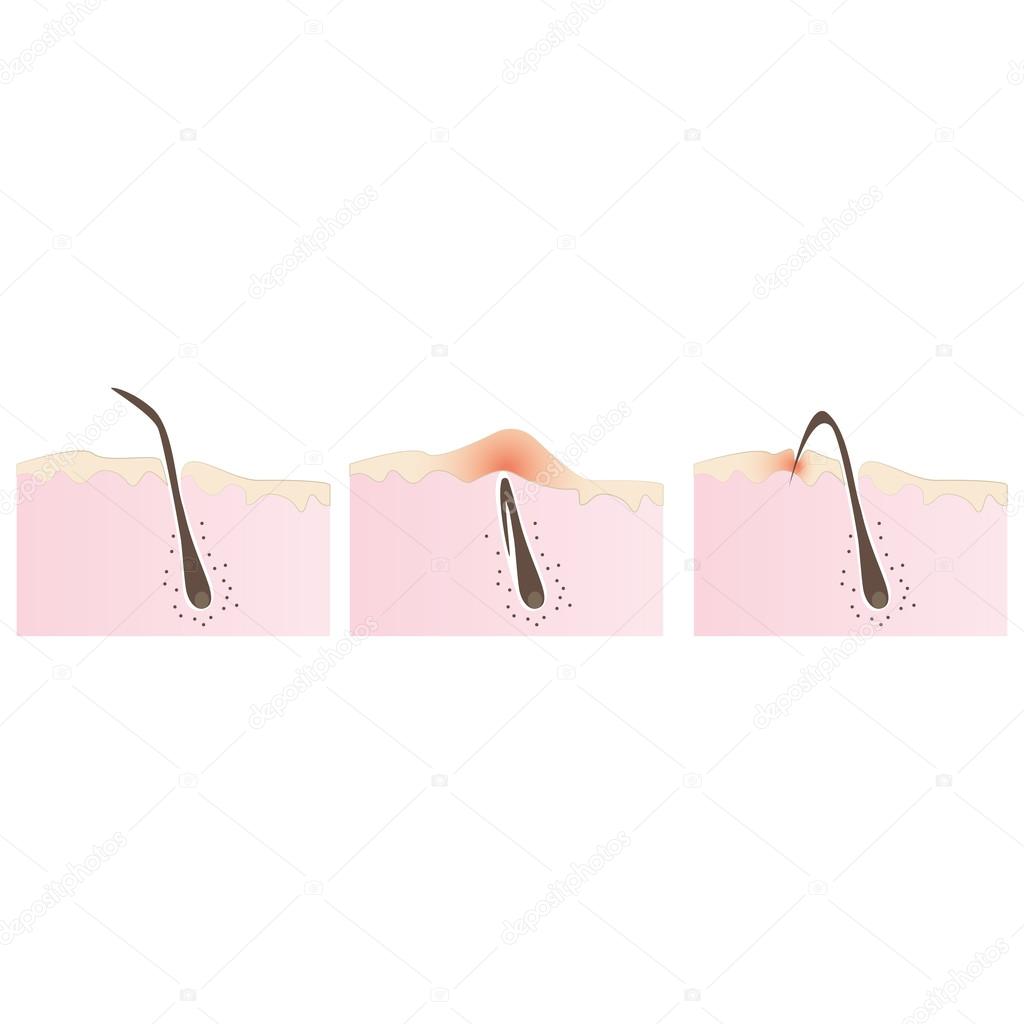 Structure of the hair follicle, ingrown hairs when shaving and depilation  Stock Vector Image by ©lannanster@ #126261544