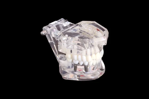 Implantes dentales aislados en un molde de un modelo de mandíbula humana sobre fondo negro con trayectoria de recorte — Foto de Stock