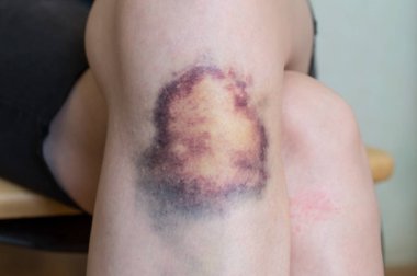 Bruise injury on knee of young woman clipart