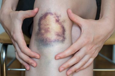 Büyük çürük zarar diz genç kadının üzerinde