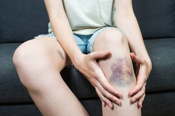 Modřinu škody na mladých žen koleno — Stock fotografie