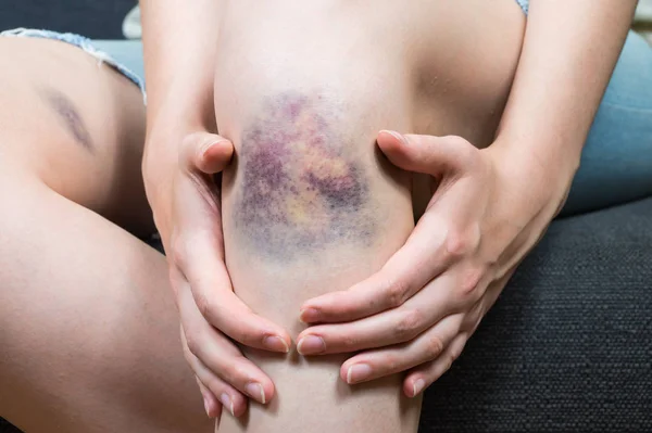 Prellungen am Knie der jungen Frau — Stockfoto