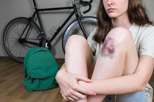 Jonge vrouw met gekneusd been na een fiets ongeluk — Stockfoto