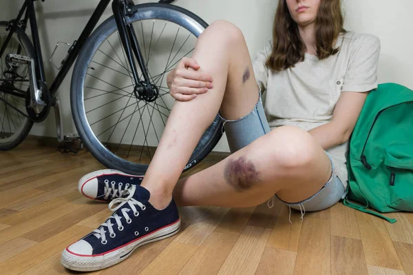 Mujer joven en ropa casual de estilo callejero con rodilla magullada descansa después de accidente de bicicleta — Foto de Stock