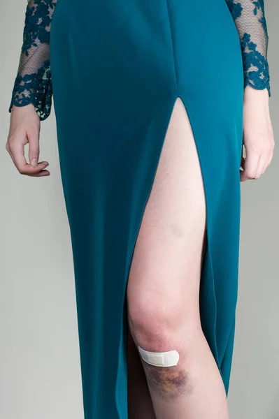 Žena ve večerních šatech s pohmožděnou zraněné koleno — Stock fotografie