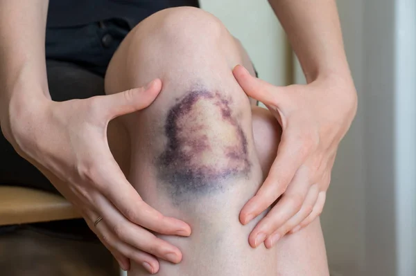 Große Prellungen am Knie der jungen Frau — Stockfoto