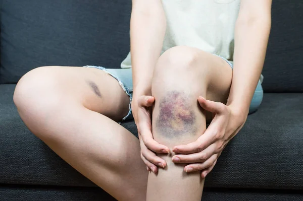 Bloeduitstorting op jong meisje knie letsel Stockfoto