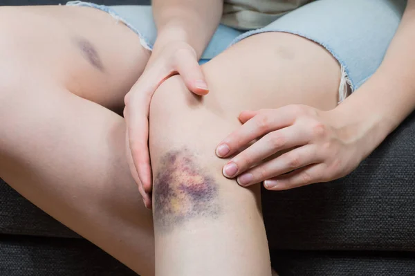 Checking bruise injury on young woman knee Royalty Free Stock Images