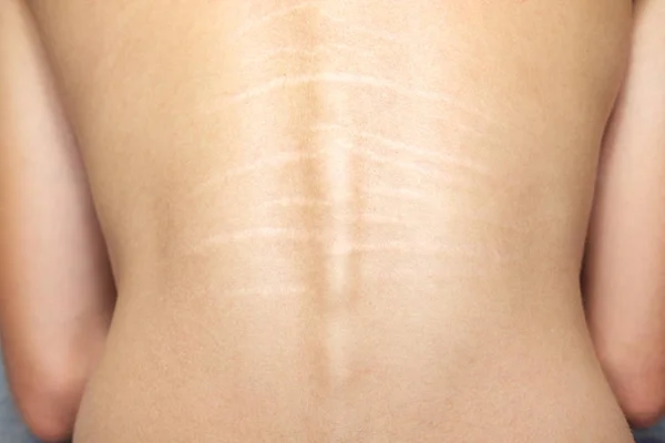 Vista cercana de la espalda con estrías en la piel . —  Fotos de Stock