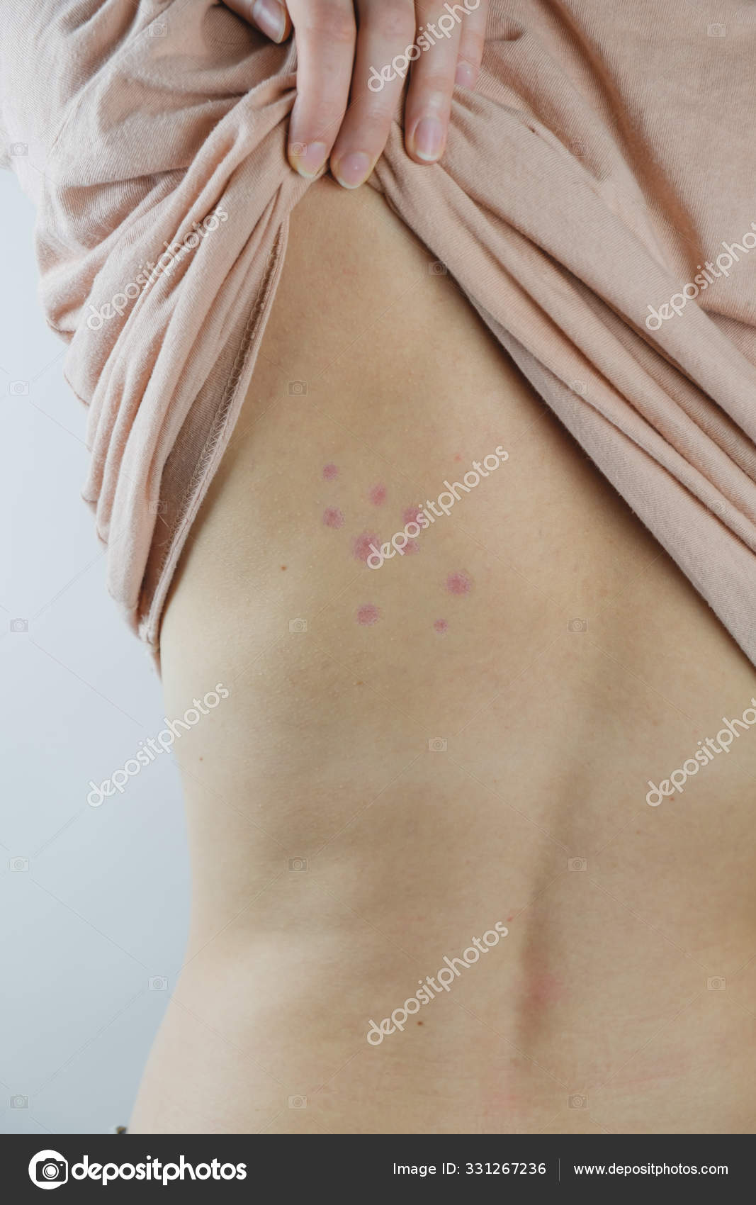 Damaged Skin Female Back Bedbug Bites Moosquito Bites Skin Disease Stock Photo By C Photoboyko 331267236