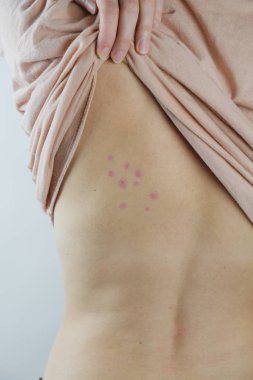 Damaged skin on female's back. Bedbug bites, moosquito bites or skin disease on human body, vertical shot clipart