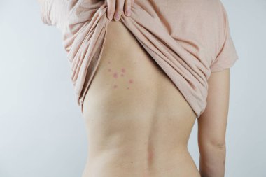 Damaged skin on female's back. Bedbug bites, moosquito bites or skin disease on human body clipart