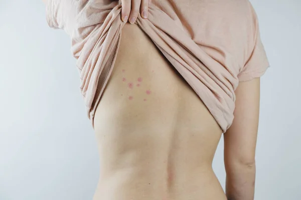 Sérült Bőr Női Háton Poloska Csípések Moosquito Csípések Vagy Bőrbetegség Stock Kép