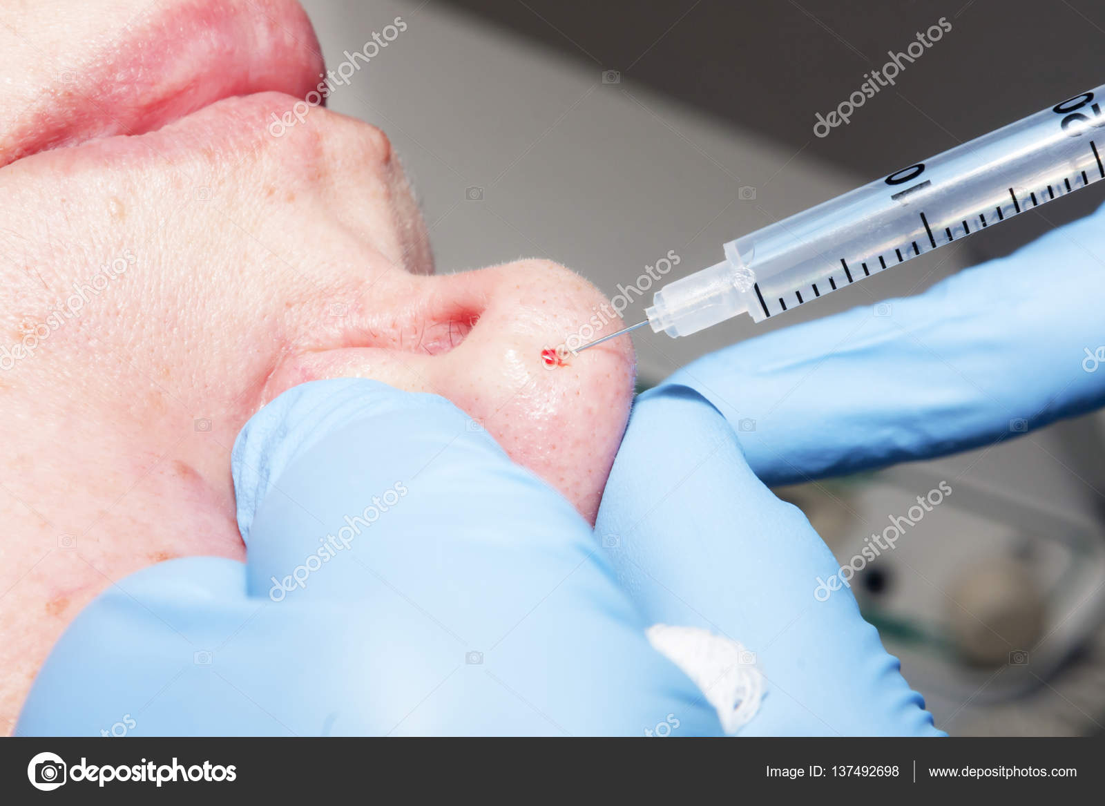 Microsurgery Doctor dermatologist performs Local anesthesia on the