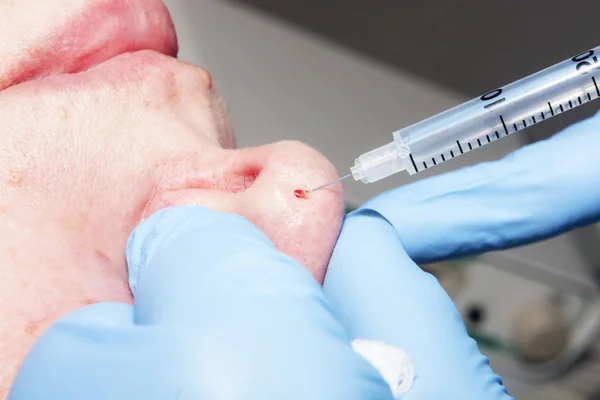 Microcirugía: El médico dermatólogo realiza anestesia local en la nariz — Foto de Stock