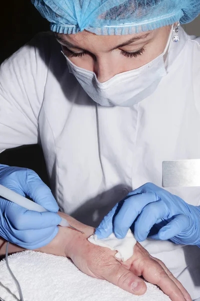 Mikrochirurgie: Lékař dermatolog s odstraněním kůže desesas — Stock fotografie