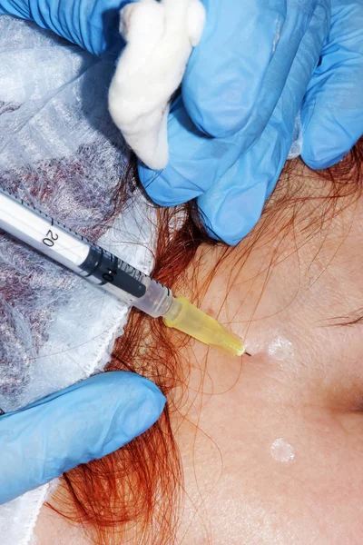 Procédure anti-âge : le dermatologue effectue l'injection de botul — Photo