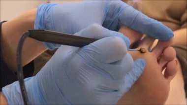 Dermatolog cerrah elektrokoter plantar siğil (Adım 3/10 kaldırmak için kullanır)