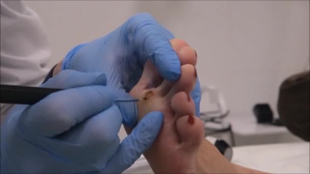 Cirujano dermatólogo utiliza electrocauterio para extirpar la verruga plantar (paso 8 / 10 ) — Vídeo de stock