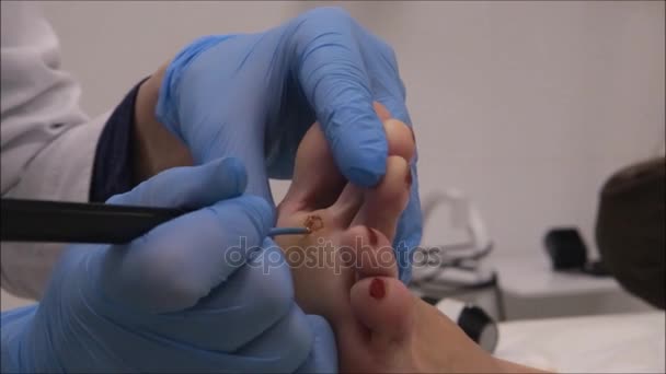 Dermatologo chirurgo per cauterizzare la ferita con elettrocoagulatore dopo l'intervento chirurgico — Video Stock