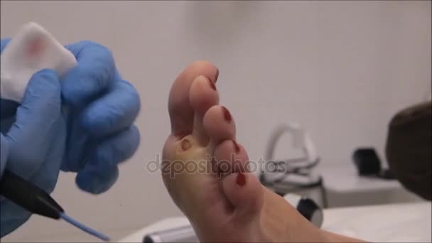 Dermatólogo cirujano utiliza el electrocauterio para eliminar la verruga plantar (paso 10 / 10 ) — Vídeo de stock