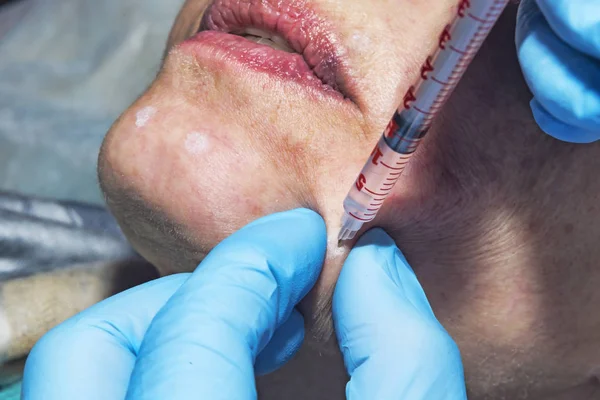 Dermatolog kosmetolog aplikuje kosmetické injekce botulotoxinu toxinu u pacienta středního věku na klinice krásy — Stock fotografie
