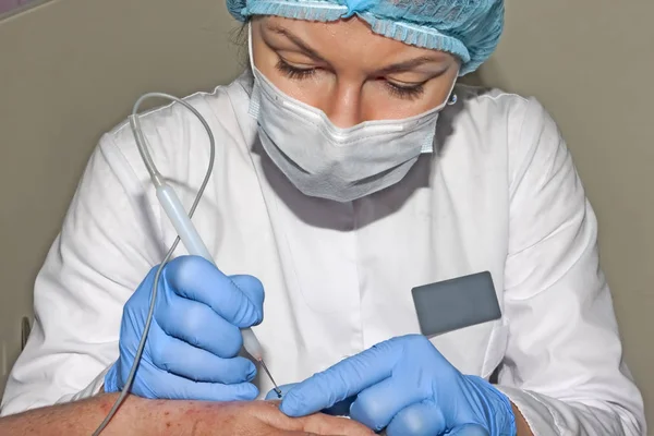 Dermatolog chirurg odstraní kožní onemocnění s electrocoagulatpr — Stock fotografie