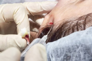 Yüz germe sonra aşırı filamentler dermatolog cerrah keser