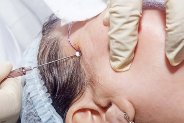 Yüz germe sonra aşırı filamentler dermatolog cerrah keser