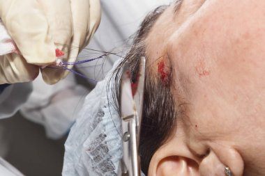 Yüz germe sonra aşırı filamentler dermatolog cerrah keser