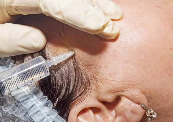 Dermatolog chirurg vyjme přebytek vlákna po zvednutí tvář — Stock fotografie