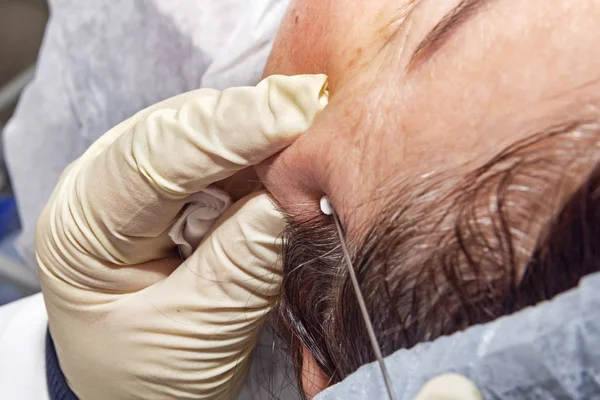 Cirujano dermatólogo corta el exceso de filamentos después del lifting facial — Foto de Stock