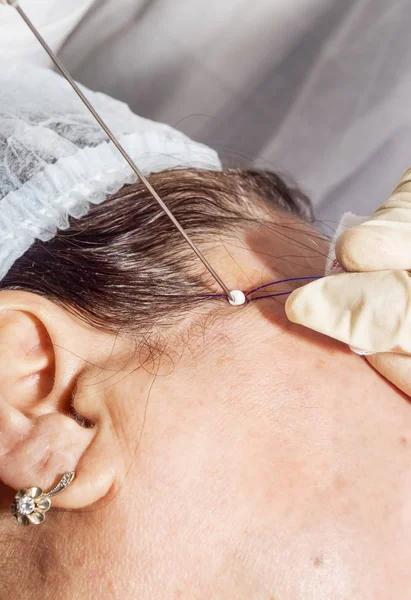 Dermatolog chirurg vyjme přebytek vlákna po zvednutí tvář — Stock fotografie