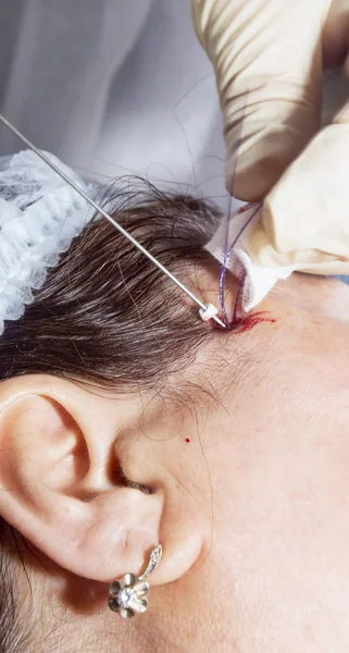 Cirujano dermatólogo corta el exceso de filamentos después del lifting facial — Foto de Stock