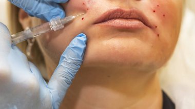 Dermatolog nasolabi düzeltilmesi için kontur plastik gerçekleştirir