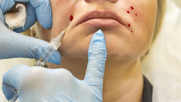 Dermatólogo realiza contorno plástico para la corrección de nasolabi — Foto de Stock