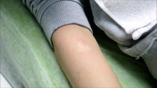 Dermatólogo realiza anestesia local en el brazo — Vídeo de stock