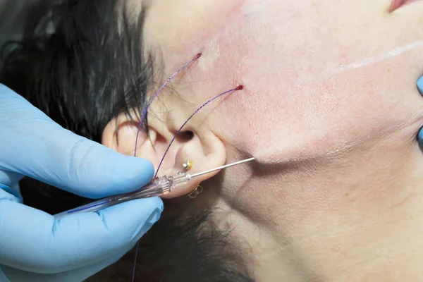 Dermatologist surgeon inserts polylactic acid filaments to perfo — Stock Photo, Image