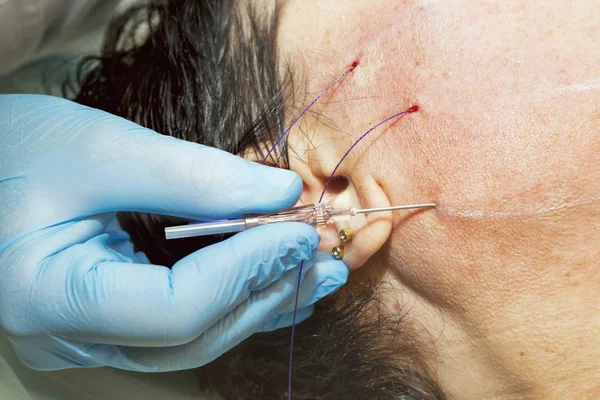 Dermatologist surgeon inserts polylactic acid filaments to perfo — Stock Photo, Image