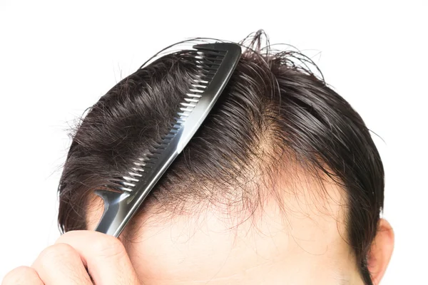 Nahaufnahme junger Mann ernstes Haarausfall-Problem für Haarausfall-Konzept — Stockfoto