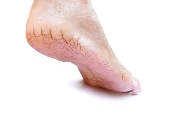 Woman cracked heels with white background, foot healthy concept — Stock Photo, Image